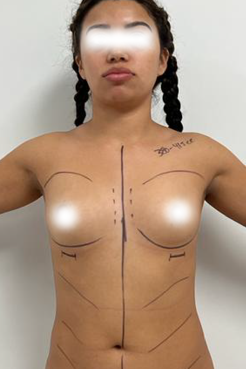Before boob lift and implants - VYO