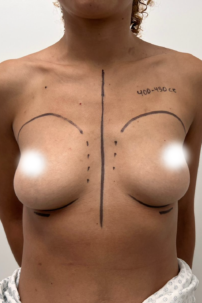 Before silicone breast augmentation - VYO