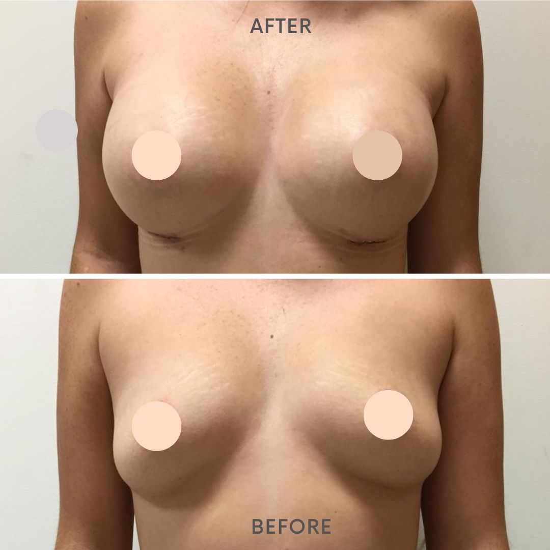Breast Augmentation Before and After
