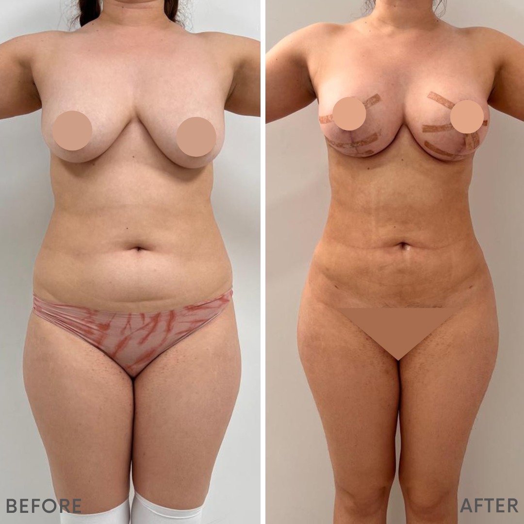 Lipo 360 Breast Lift Before and After