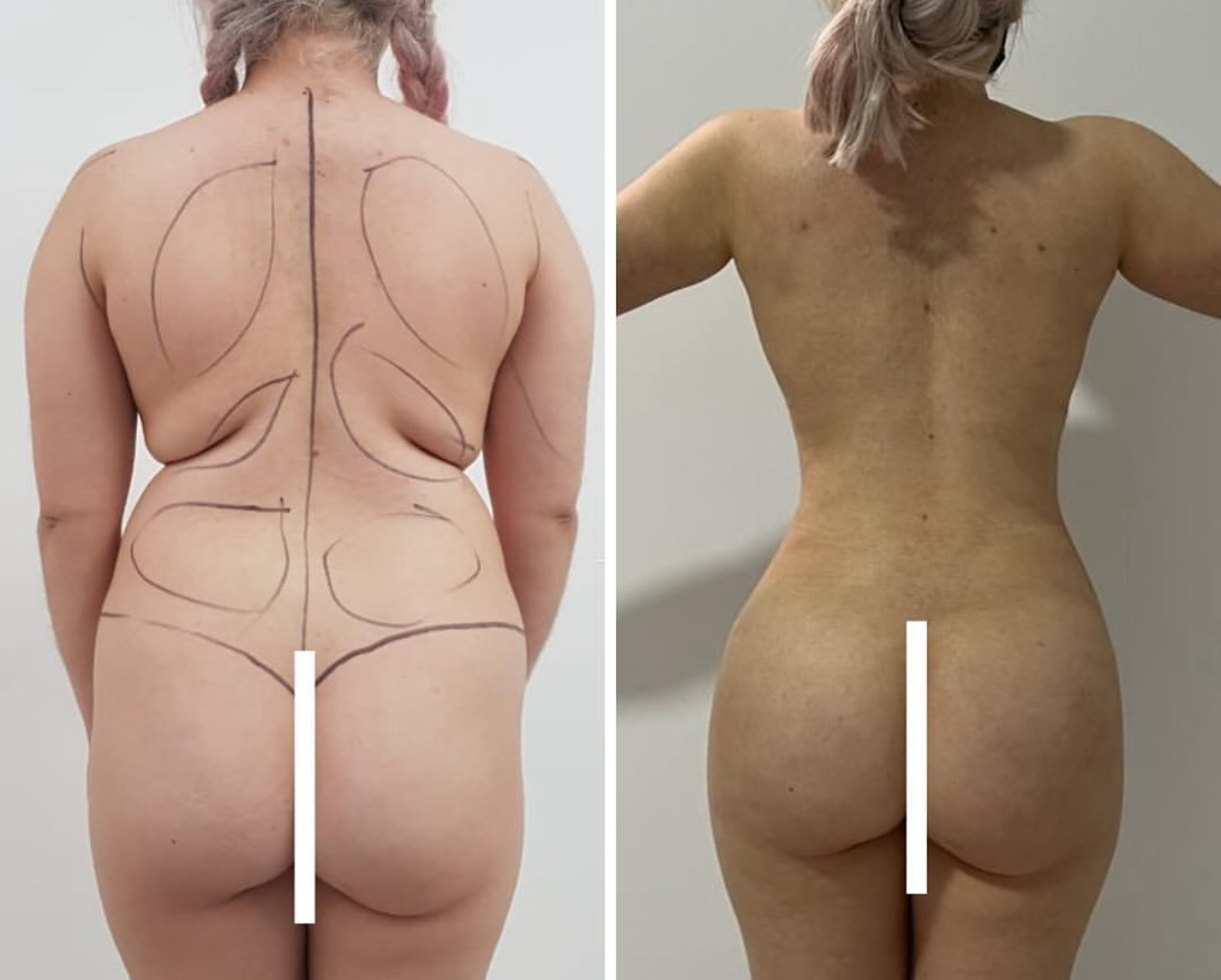 Lipo 360 BBL Before and After