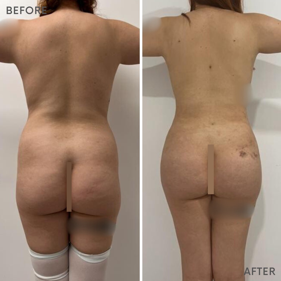 Lipo 360 Before and After